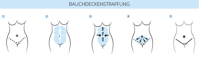 Grafik Bauchdeckenstraffung Zürich / Schweiz, mytummy, Dr. Köhler, prevention-center  